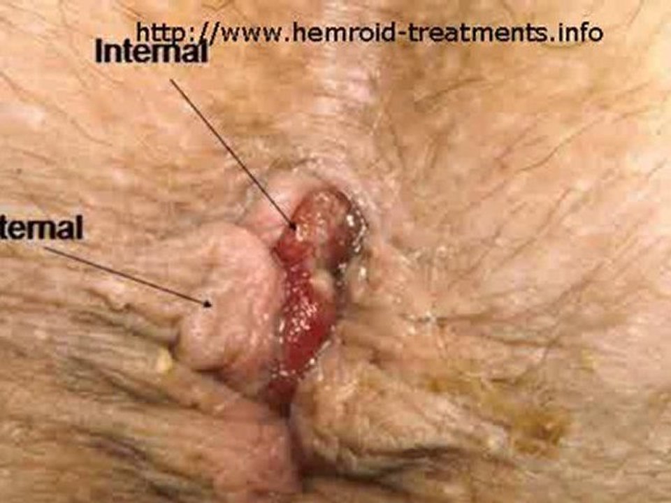 Cure Hemorrhoids