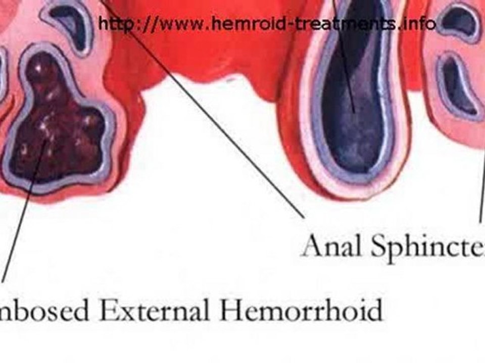 You Can Become Hemorrhoid Free