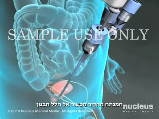 Radical Prostatectomy Surgery in India with best medical treatment and best urosurgeons.