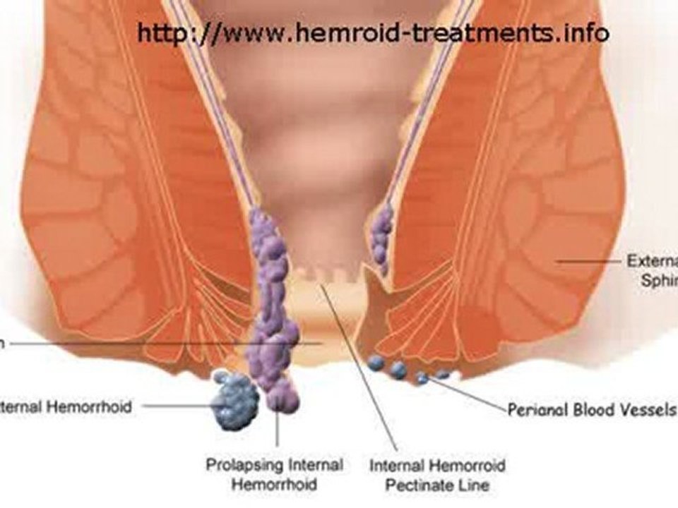 No Surgery Cure For Hemorrhoids
