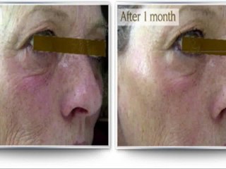 Want relief of Rosacea? Look here!!