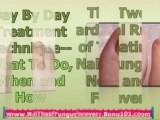 how to treat toenail fungus - how to get rid of nail fungus - toenail fungus home treatment