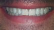 Teeth Straightening Invisalign Austin Tx- Lakeway Clear Braces