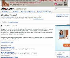 Gahanna Dentist- What is a Veneer?