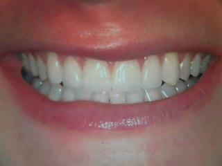 Front teeth Gaps fixed - Veneers Austin, Tx- Lakeway