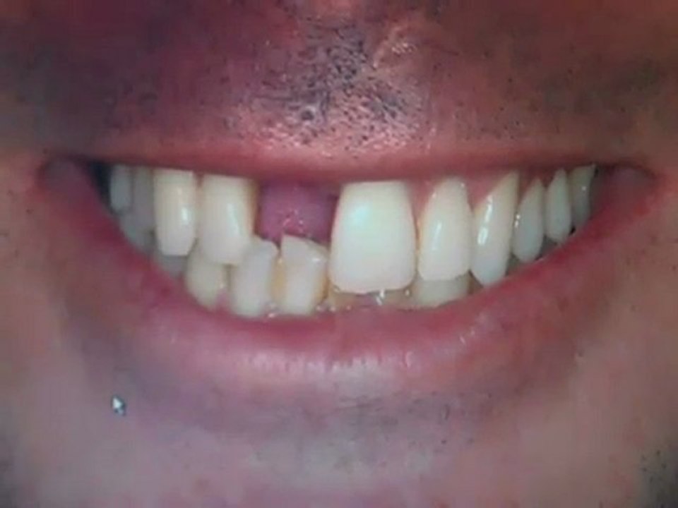 Dental Implants Austin, TX Lakeway Before and after Photos video