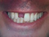 Dental Implants Austin, TX- Lakeway Before and after Photos