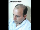 pakistan hair transplant,hair transplant in pakistan,FUE in lahore