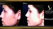 Rhinoplasty at Robinson Facial Plastic Surgery - Atlanta, GA