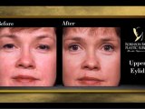 Upper Eyelid Surgery (Blepharoplasty) - Atlanta, GA