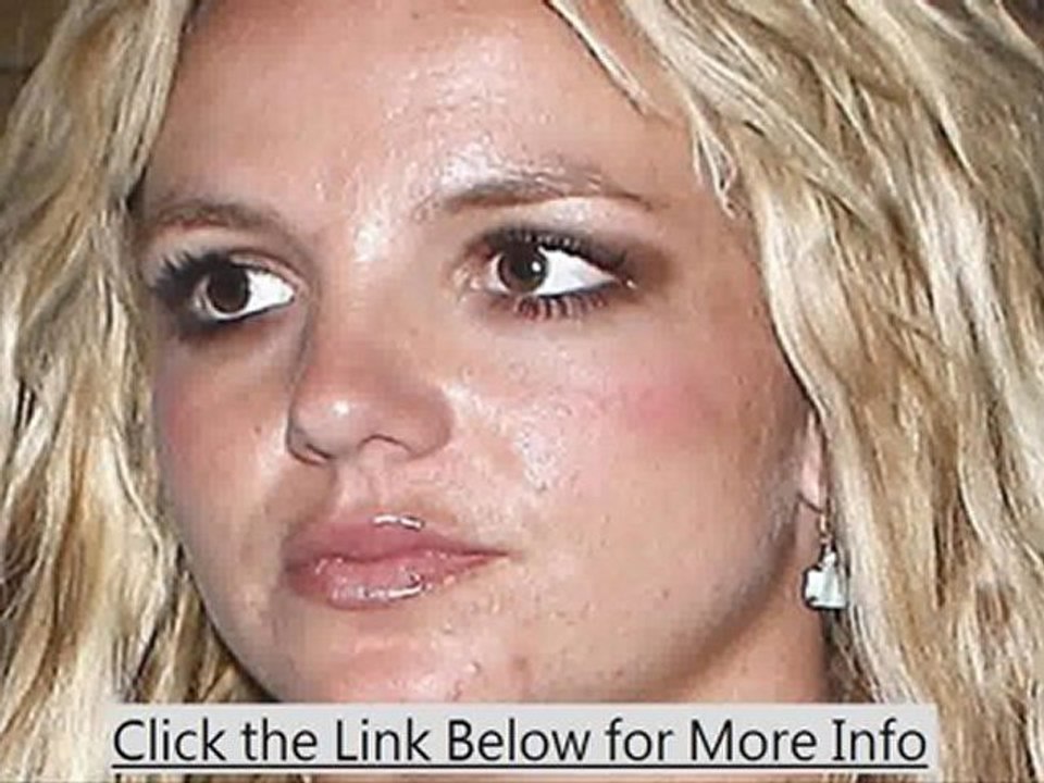 quick acne cure.