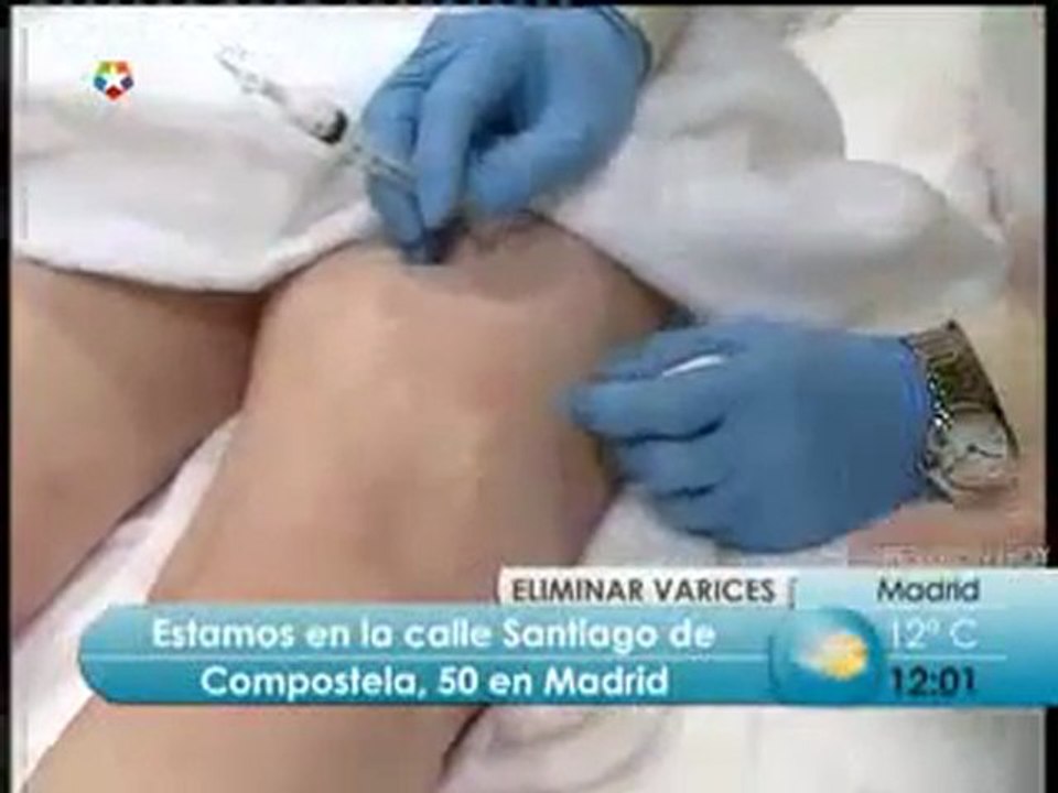 Eliminación de varices con microespuma en INSTIMED (Telemadrid)