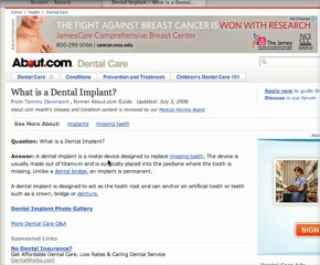 Gahanna Dentist- What is a Dental Implant?