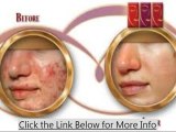 Permanently Cure Your Acne Within 2 Months