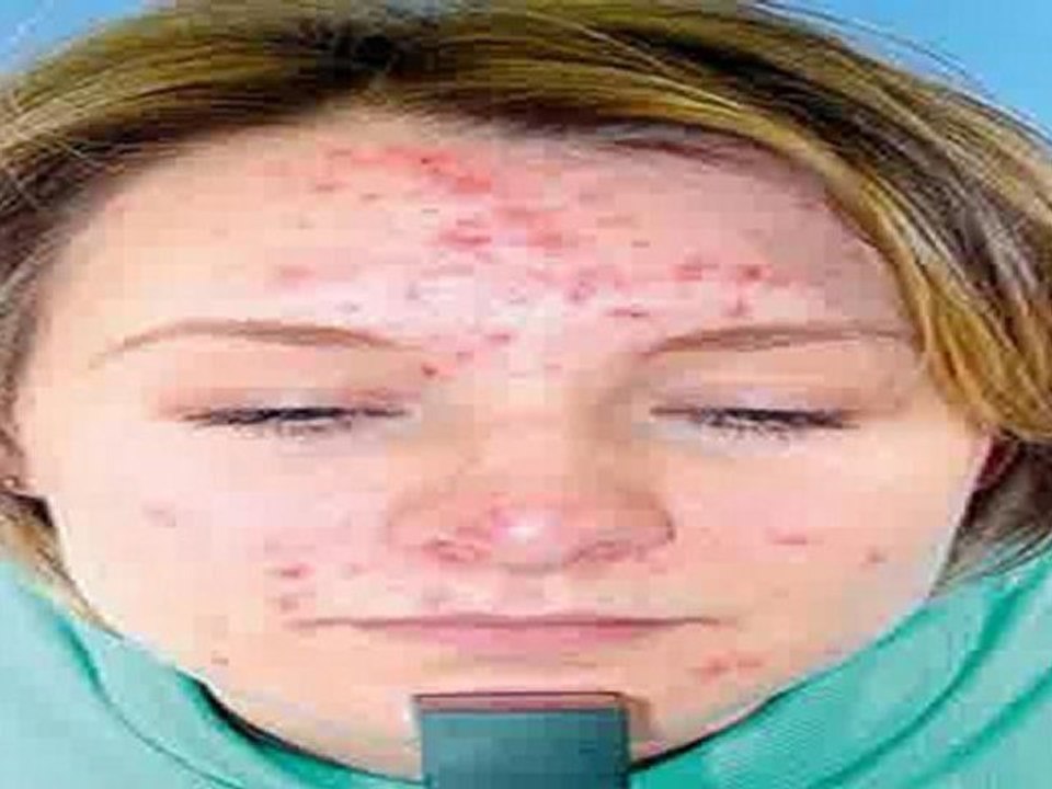 Acne Cure