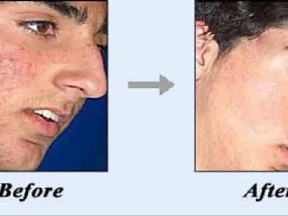 Natural Acne Treatment