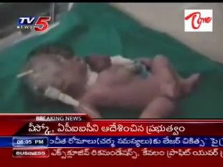 Heart is out side of the chest-just born baby_Cuddapa