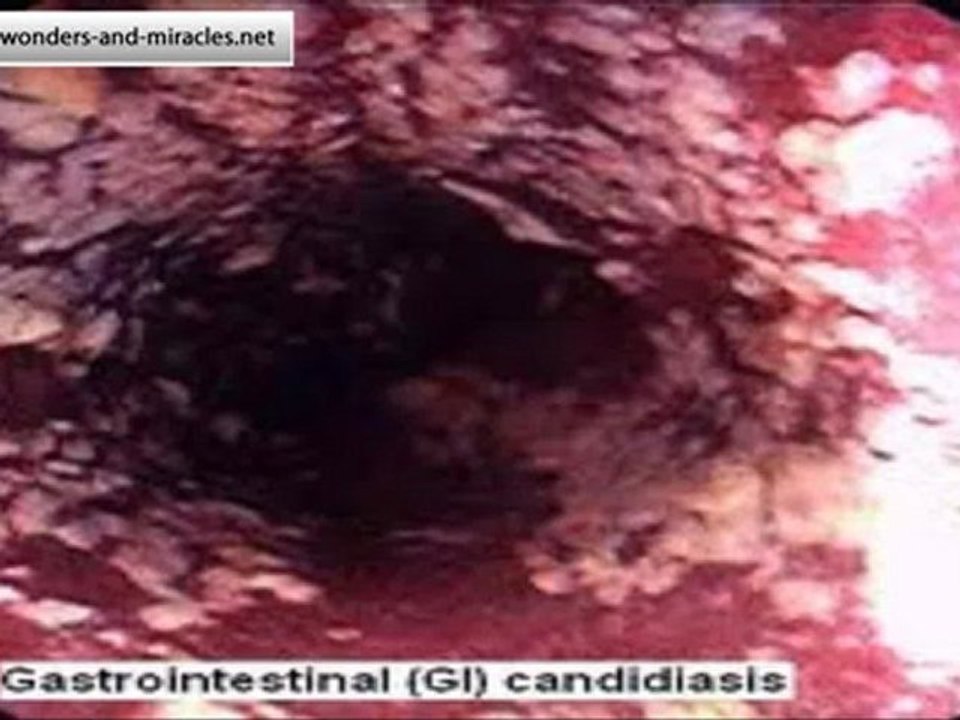 candida treatment