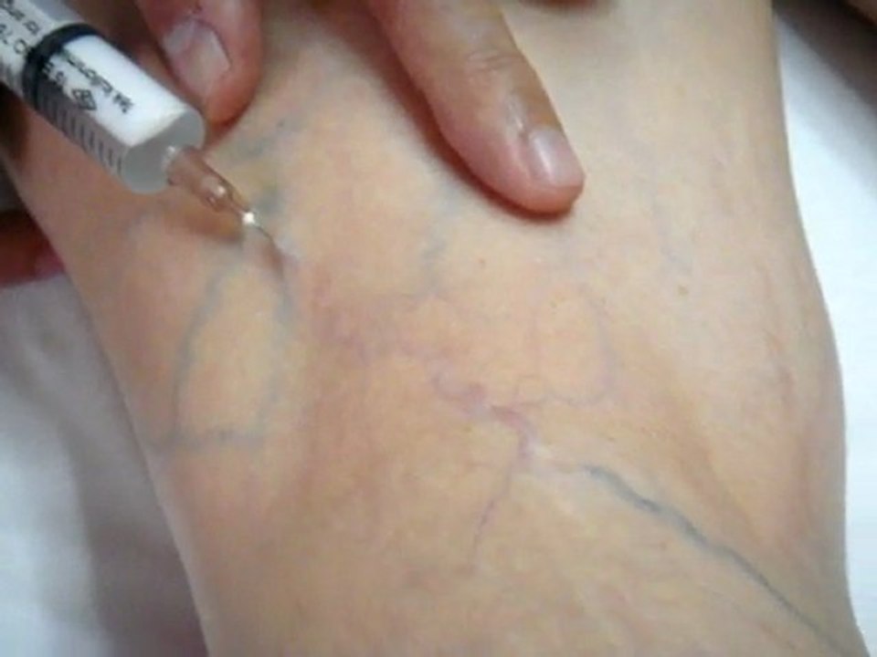 Opr.Dr.Cafer Abbasoğlu Lenf Ödem Tedavisi