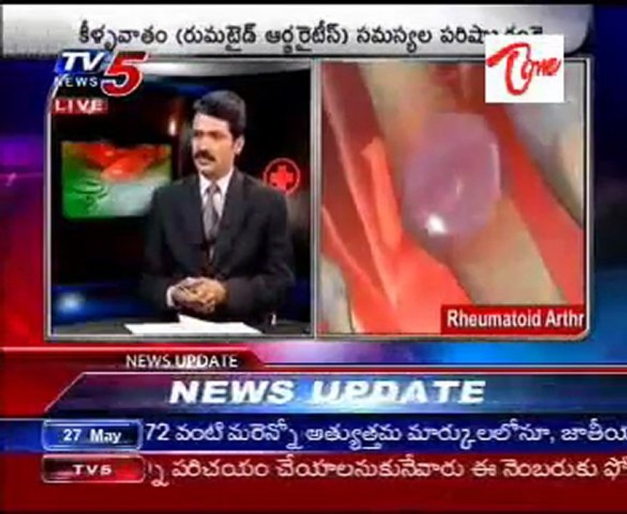 Rheumatoid Arthritis Problems - Doctor Suggestions - Part1