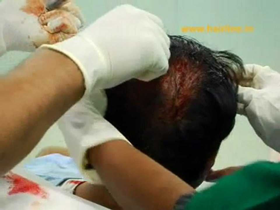PRP Hair Loss Treatment in Bangalore Reviews