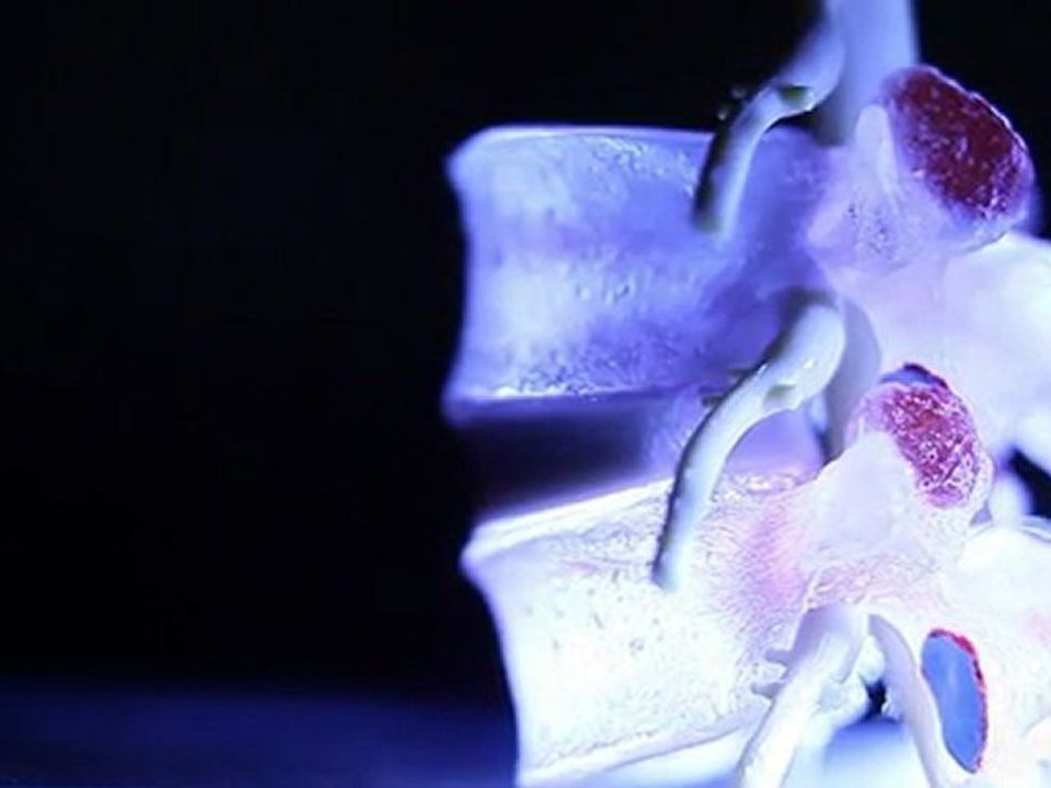 Hernie discale | La Technique Cox - flexion distraction et décompression.