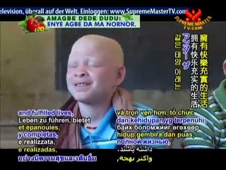 Ensuring People with Albinism Live Under The Same Sun
