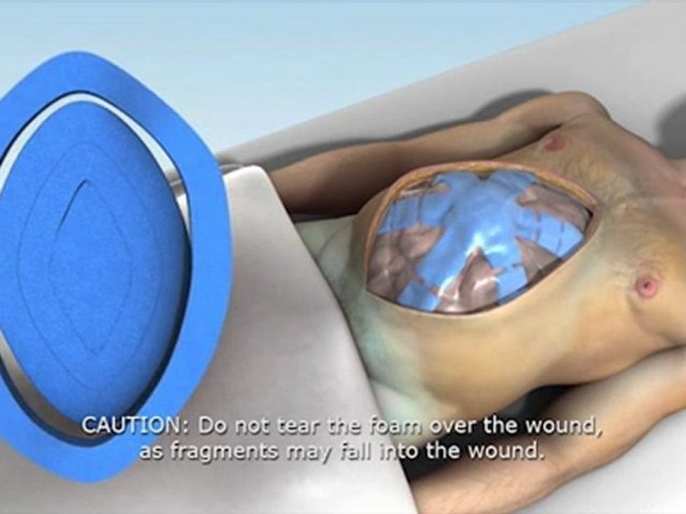 Open Abdomen Negative Pressure Therapy System | ABThera | KCI