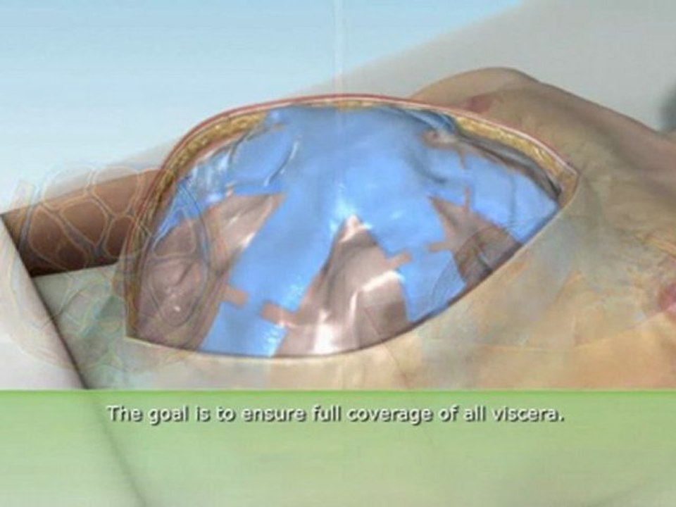 Open Abdomen Management | ABThera | KCI