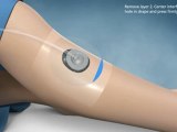 Negative Pressure Wound Therapy System (NPWT) | V.A.C. Via | KCI