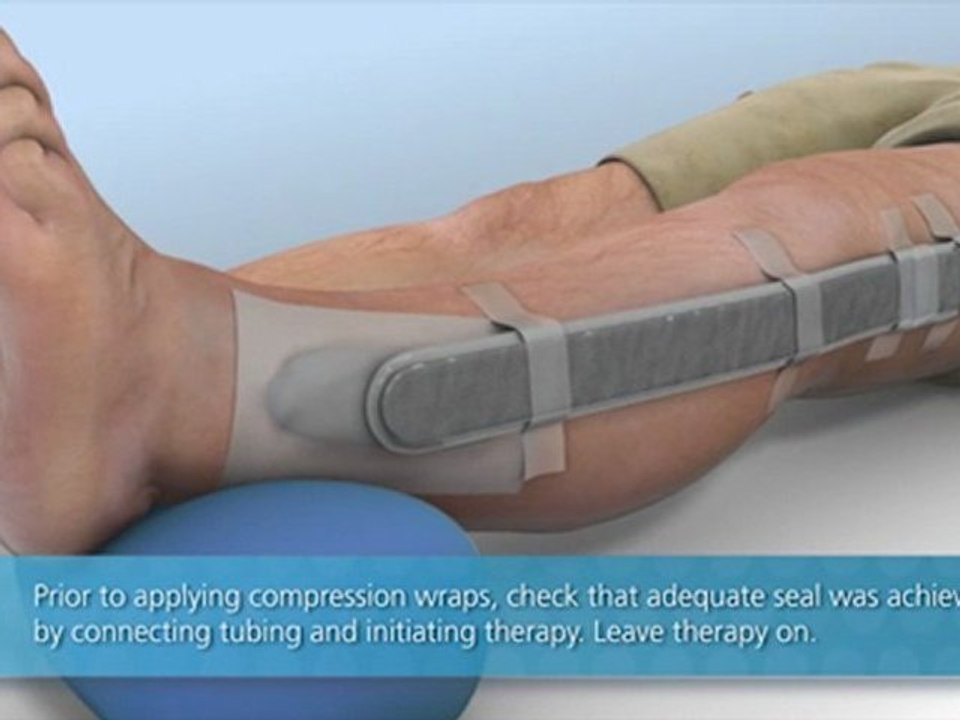 Wound Dressing Application V.A.C. GranuFoam Bridge XG Dressing KCI
