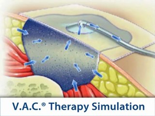 Wound Management | V.A.C. Therapy System | KCI