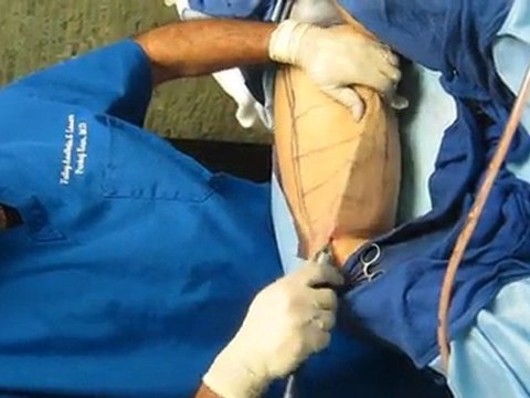 SmartLipo Laser Liposuction-Valley Aesthetics and Laser-626-961-7700