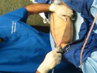 SmartLipo Laser Liposuction-Valley Aesthetics and Laser-Hacienda Heights-626-961-7700