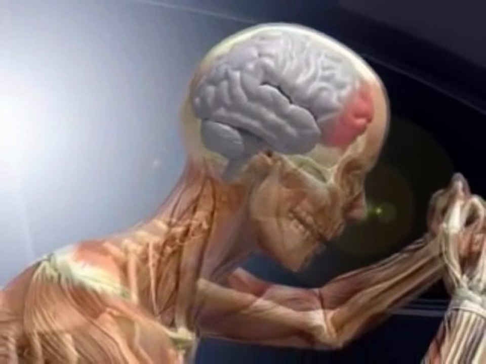3D Brain-Skull injury (TBI): Car accident reconstruction