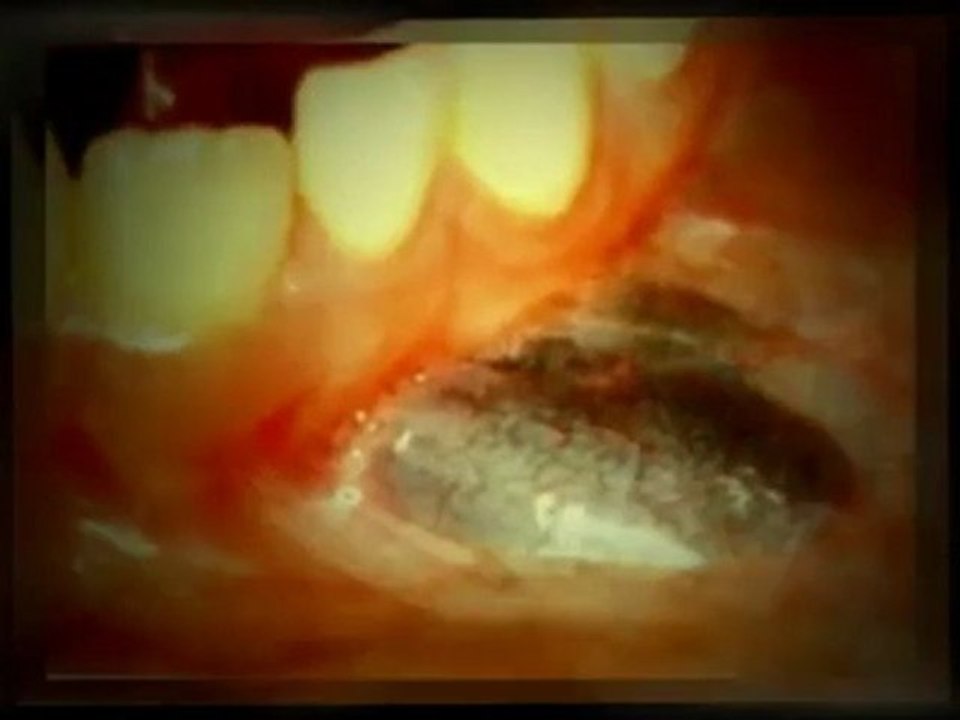 Oral chelation therapy for heavy metal detox