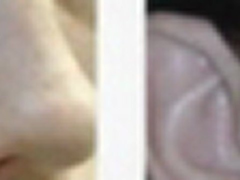 acne scars treatments NYC