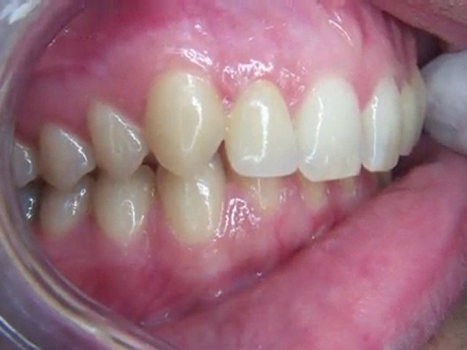 Facettes céramique collée: sourire avant- après