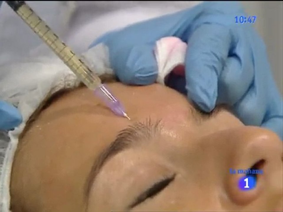 Mesoterapia facial, la mañana de la 1