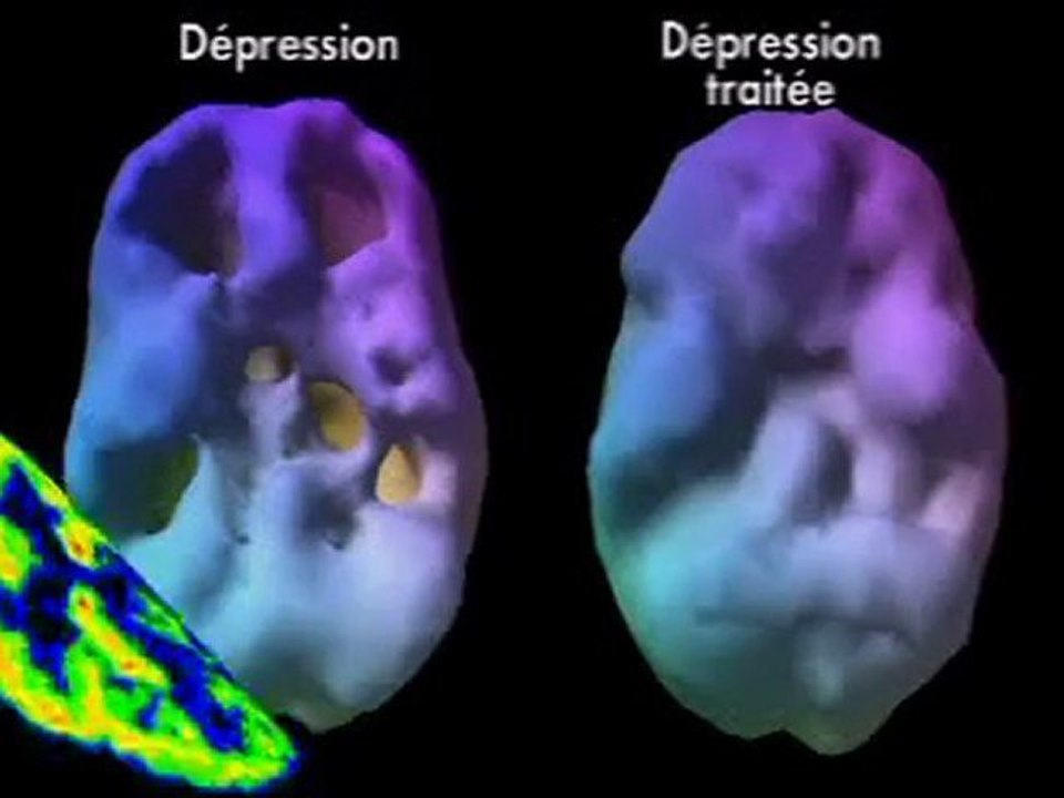 La dépression