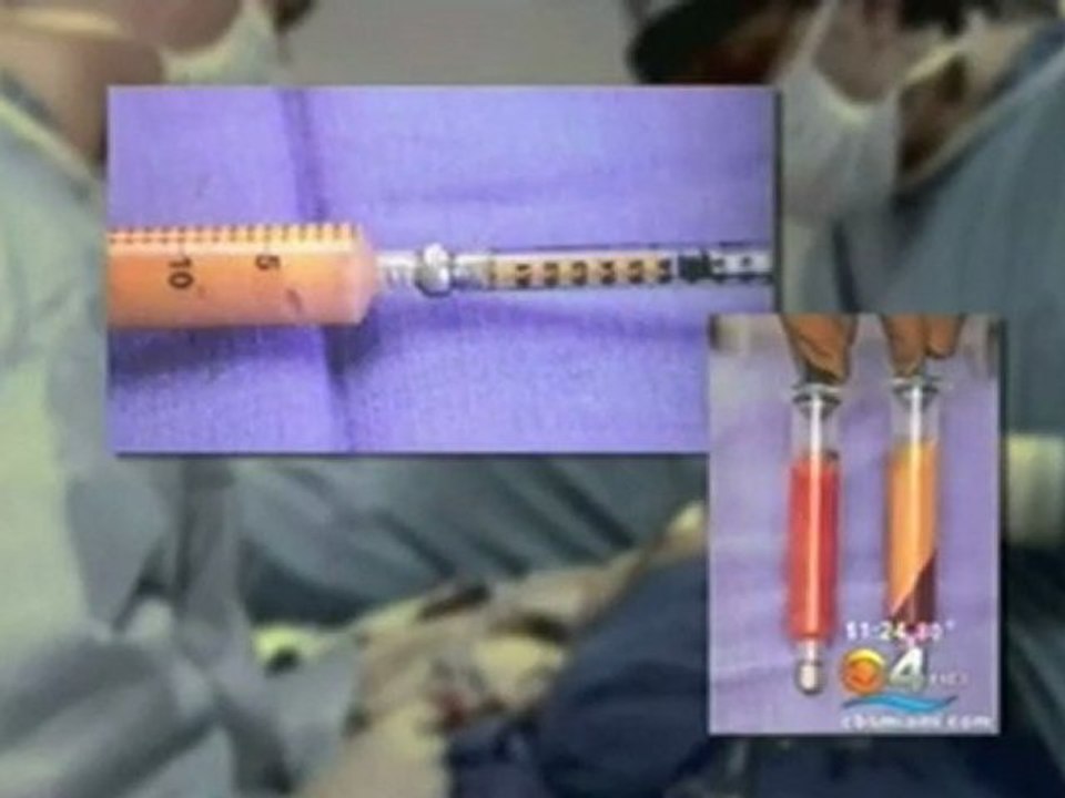 Fat Grafting Specialist on CBS News