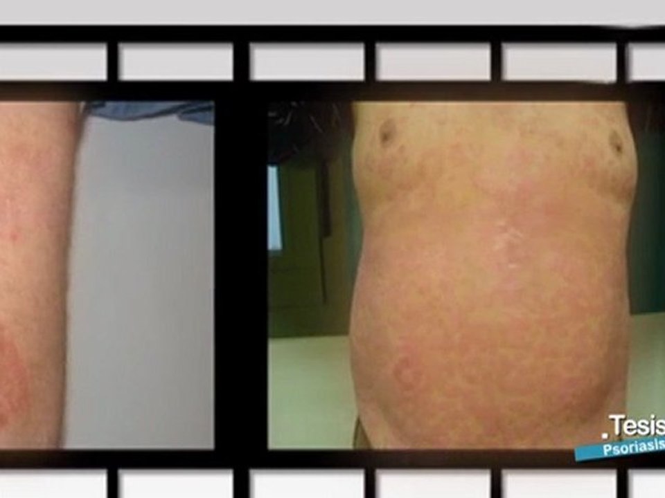 Psoriasis