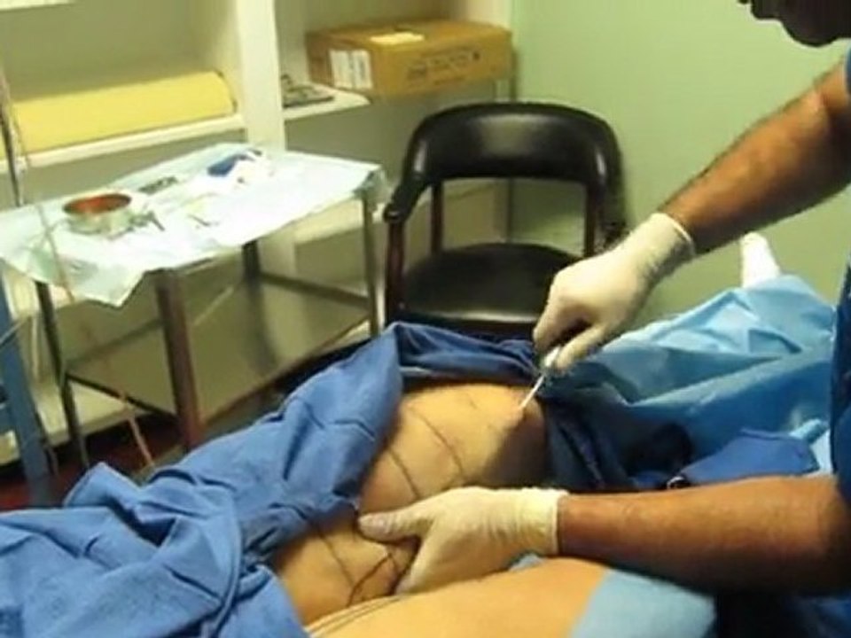 SmartLipo Laser Liposuction-Anaheim-Fullerton-Irvine-Pasadena-Burbank-Orange-Los Angeles-Orange County-