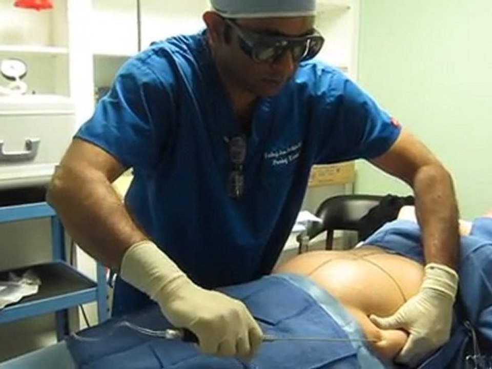 SmartLipo-Laser Liposuction-Valley Aesthetics and Laser-Hacienda Heights-626-961-7700