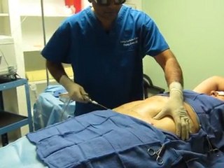 SmartLipo Liposuction-Pasadena-Whittier-La Mirada-La Habra-Brea-Fullerton