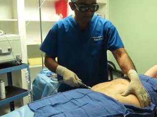 Abdomen-Flanks-Liposuction-Los Angeles-Burbank-Hollywood-Sherman Oak-Northridge