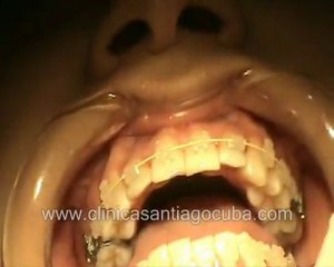 BRAQUETS  EN LA CLINICA SANTIAGO CUBA