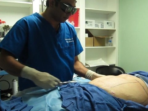 SmartLipo Laser Liposuction- Abdomen and Flanks-Valley Aesthetics and laser-Pankaj Karan,M.D.
