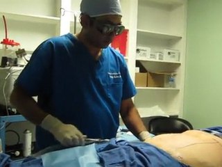 Liposuction Of Abdomen and Flanks ( Love Handles)-Pankaj Karan,M.D.