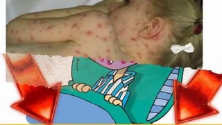 cure chickenpox - chickenpox cure - chickenpox cures - chicken pox cure